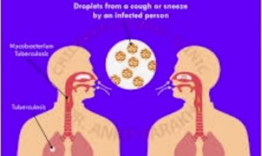 जिला में टीबी के 675 केस एक्टिव,जिला में सर्वे के लिए 5 टीमों का किया गठन सैंपल की अलग-अलग स्तर पर की जा रही जांच