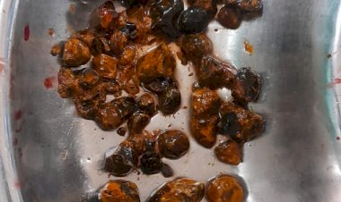 55 वर्षीय महिला के नलिका से ऑपरेशन निकाली 65 पत्थरियां