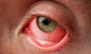 स्कूल मुखियां प्रातः कालीन सभा में बच्चों को आई फ्लू बारे करें जागरूक