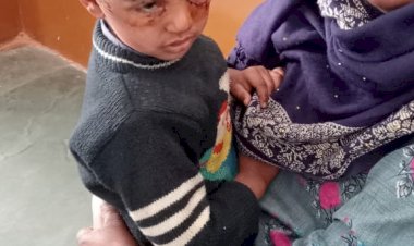 सिंघपुरा में बीती रात, कुत्ते ने सोए नौनिहाल पर किया हमला, बुरी तरह से किया जख्मी